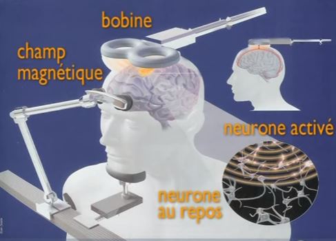 Stimulation magnétique transcrânienne (rTMS) - Pôle Psychiatrie Centre à l’Hôpital de la Conception